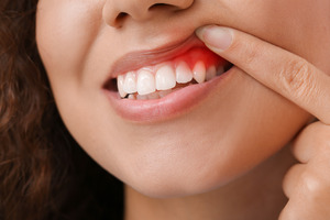 Woman lifting lip to show signs of gingivitis